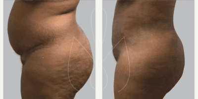 Case 2874 - Woman treated with Tummy Tuck