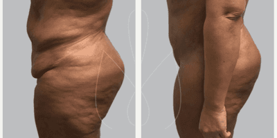 Case 2875 - Woman treated with Tummy Tuck