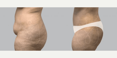 Case 2891 - Woman treated with Tummy Tuck