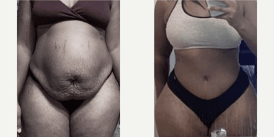 Case 293 - Woman treated with Tummy Tuck