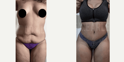 Case 294 - Woman treated with Tummy Tuck