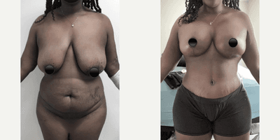 Case 312 - Woman treated with Tummy Tuck