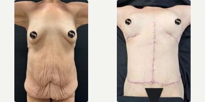 Case 3129 - 35-44 year old woman treated with Mommy Makeover, Tummy Tuck, Back Lift, Breast Lift with Implants, Brazilian Butt Lift