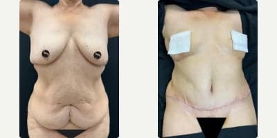 Case 3131 - 45-54 year old woman treated with Tummy Tuck, Back Lift