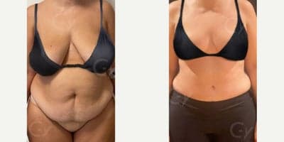 Case 3152 - 55-64 year old woman treated with Mommy Makeover, Breast Lift, Tummy Tuck