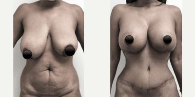 Case 322 - Woman treated with Tummy Tuck