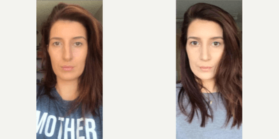 Case 3251 - Woman treated with Rhinoplasty