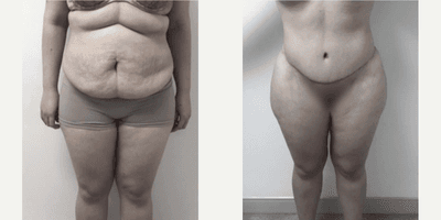 Case 333 - Woman treated with Tummy Tuck