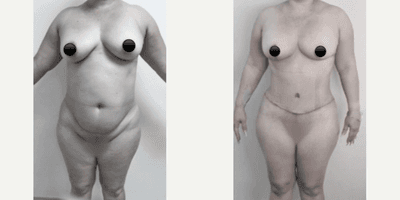 Case 334 - Woman treated with Tummy Tuck