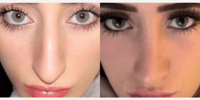 Case 3368 - Woman treated with Rhinoplasty