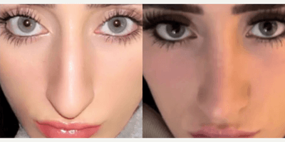 Case 3380 - Woman treated with Rhinoplasty