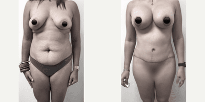 Case 345 - Woman treated with Tummy Tuck