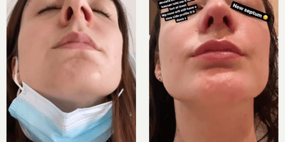 Case 3459 - Woman treated with Rhinoplasty