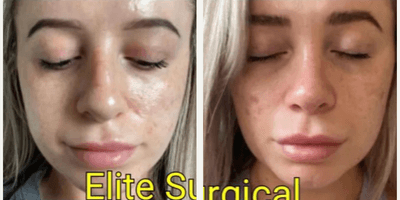 Case 3460 - Woman treated with Rhinoplasty