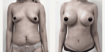 Case 347 - Woman treated with Tummy Tuck