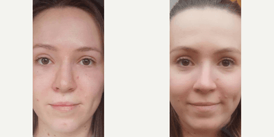 Case 3471 - Woman treated with Rhinoplasty