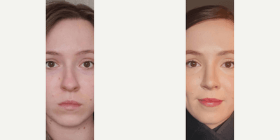 Case 3472 - Woman treated with Rhinoplasty