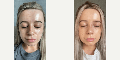 Case 3474 - Woman treated with Rhinoplasty