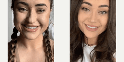 Case 3475 - Woman treated with Rhinoplasty