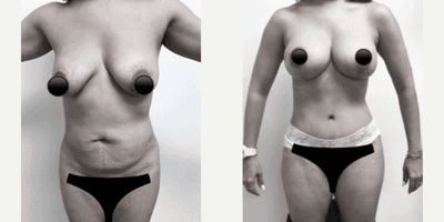 Case 348 - Woman treated with Tummy Tuck
