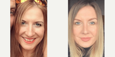 Case 3488 - Woman treated with Rhinoplasty