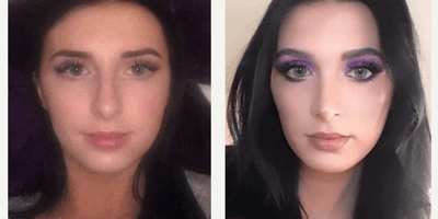 Case 3489 - Woman treated with Rhinoplasty