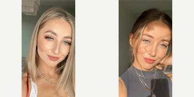 Case 3490 - Woman treated with Rhinoplasty