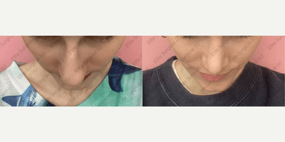 Case 3498 - Woman treated with Rhinoplasty