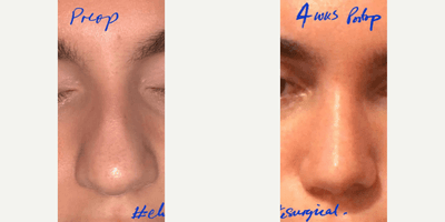 Case 3499 - Man treated with Rhinoplasty