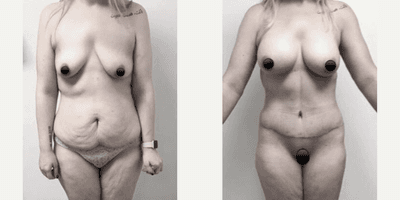 Case 350 - Woman treated with Tummy Tuck