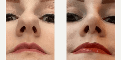 Case 3500 - Woman treated with Rhinoplasty
