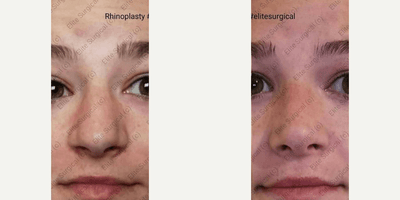 Case 3502 - Woman treated with Rhinoplasty
