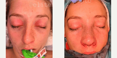 Case 3503 - Woman treated with Rhinoplasty