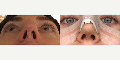 Case 3504 - Woman treated with Rhinoplasty