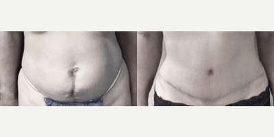 Case 351 - Woman treated with Tummy Tuck
