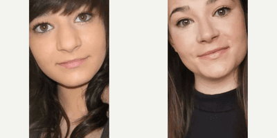 Case 3512 - Woman treated with Rhinoplasty