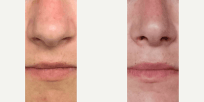 Case 3513 - Woman treated with Rhinoplasty