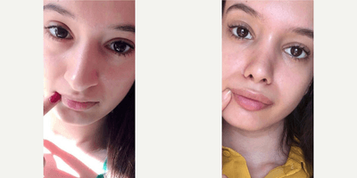 Case 3514 - Woman treated with Rhinoplasty