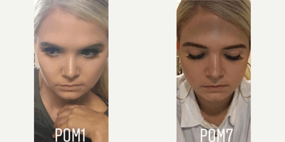 Case 3520 - Woman treated with Rhinoplasty