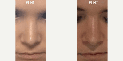 Case 3521 - Woman treated with Rhinoplasty