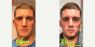 Case 3523 - Man treated with Rhinoplasty