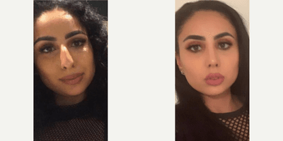Case 3524 - Woman treated with Rhinoplasty
