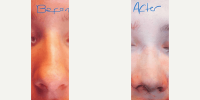 Case 3528 - Woman treated with Rhinoplasty