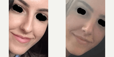 Case 3529 - Woman treated with Rhinoplasty