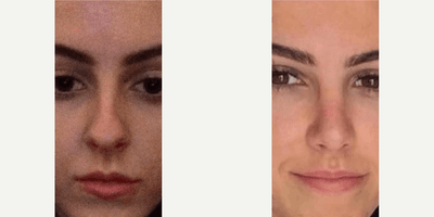 Case 3532 - Woman treated with Rhinoplasty