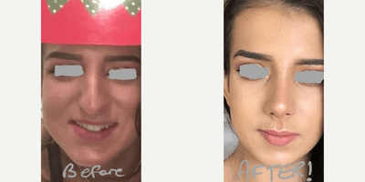 Case 3537 - Woman treated with Rhinoplasty