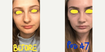 Case 3538 - Woman treated with Rhinoplasty