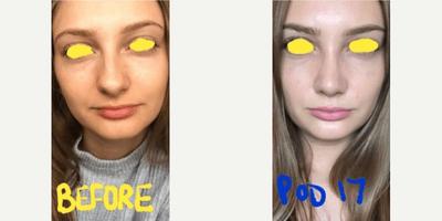 Case 3539 - Woman treated with Rhinoplasty