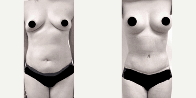 Case 354 - Woman treated with Tummy Tuck