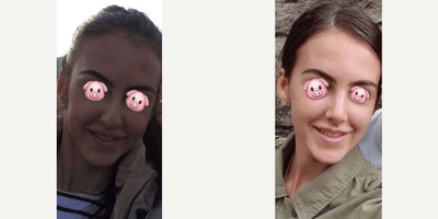 Case 3546 - Woman treated with Rhinoplasty